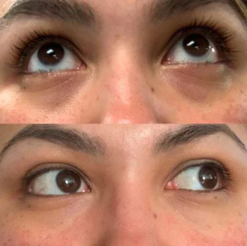 EYEPHALT - CREMA ANTI OJERAS Y BOLSAS - 49% OFF + ENVÍO GRATIS